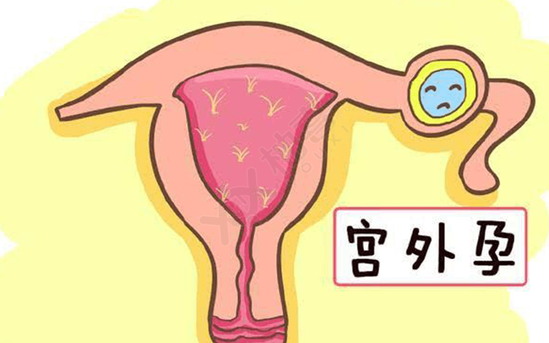 盆腔粘连可能会引起宫外孕