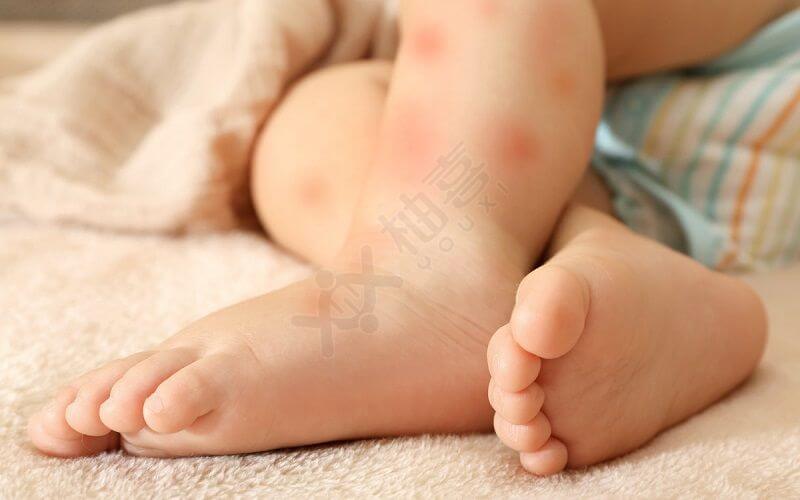 胎毒会引起宝宝湿疹