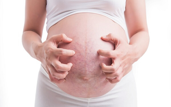 妊娠纹的2大预防方法，这几类容易长的女性更要注意！