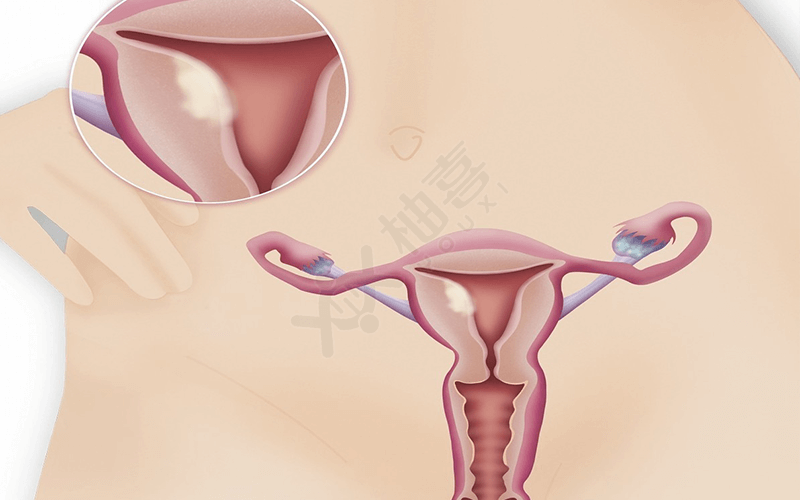 孕妇宫腔感染会导致早产