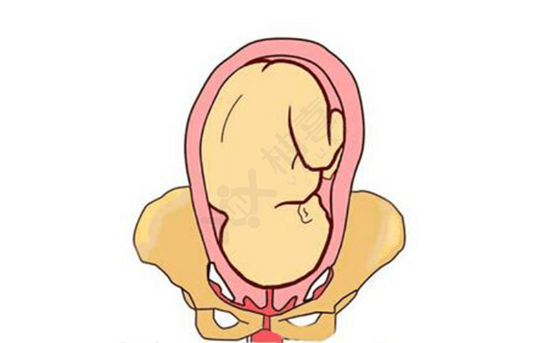 胎位roa是一种常见的体位