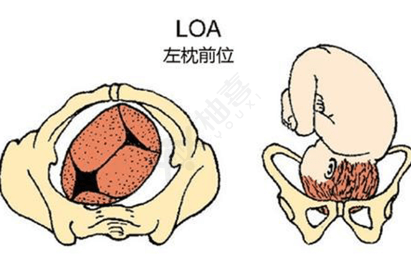 胎位LOA与LOT的区别图片