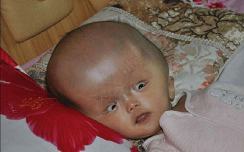 婴儿患大头症的图片
