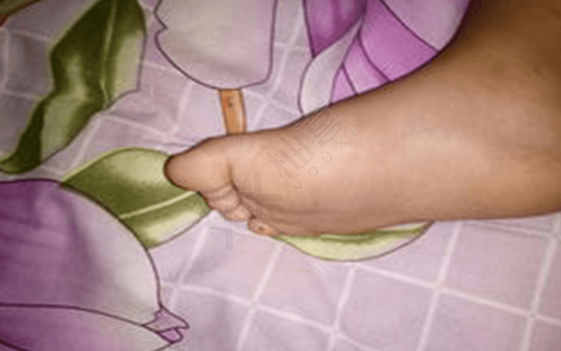 孕妇孕晚期会出现手肿脚肿的情况