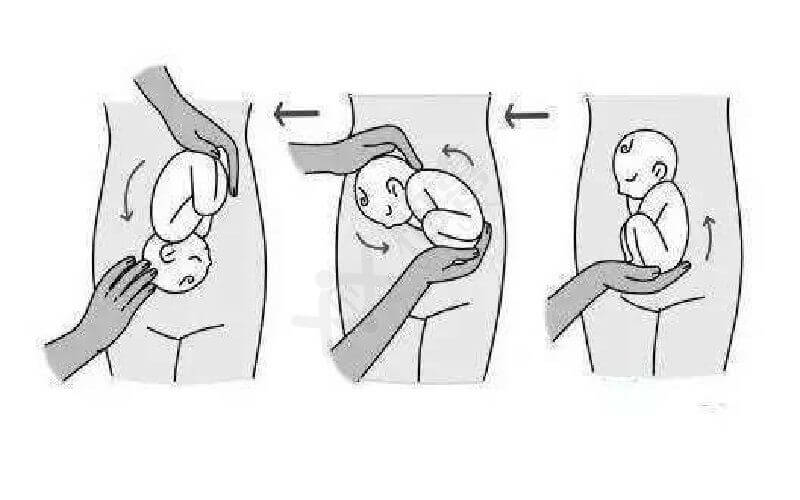 孕妇枕后位调整姿势图图片