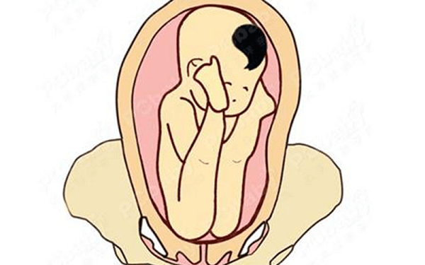 盘点二胎容易臀位的5大原因，产道松弛脱不了干系