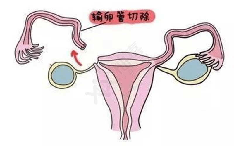 输卵管切除对怀孕的影响很大