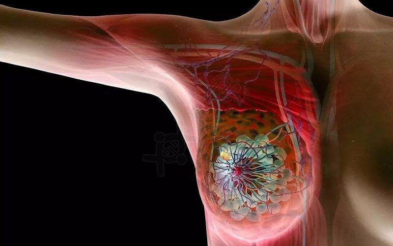 乳腺癌和乳腺炎的关系