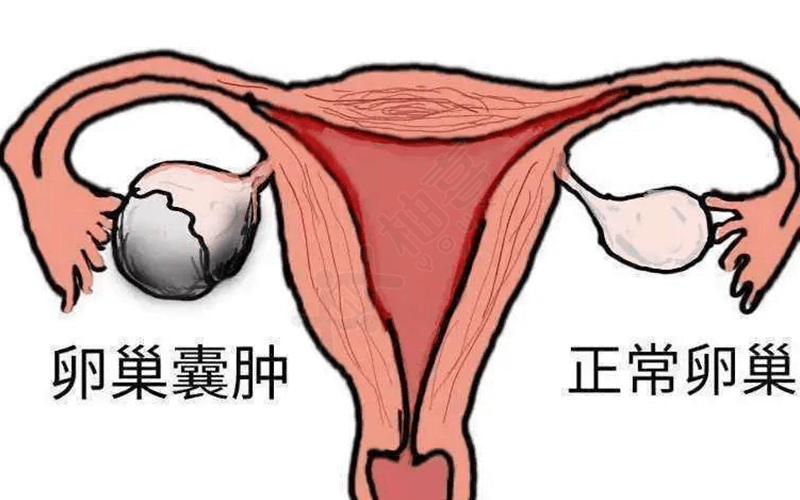 徐清宣堂肠覃膏主要用于治疗卵巢囊肿