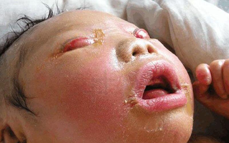 火棉胶婴儿是典型的皮肤遗传病