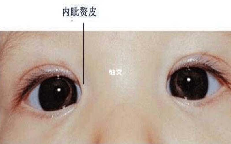 婴儿斗鸡眼的原因有皮肤遮挡