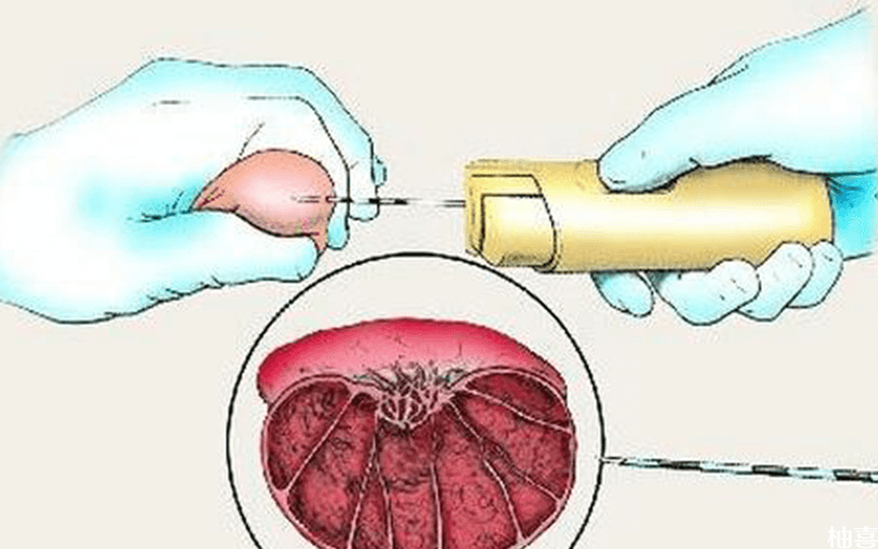 睾丸穿刺是为了检查男性的生精功能