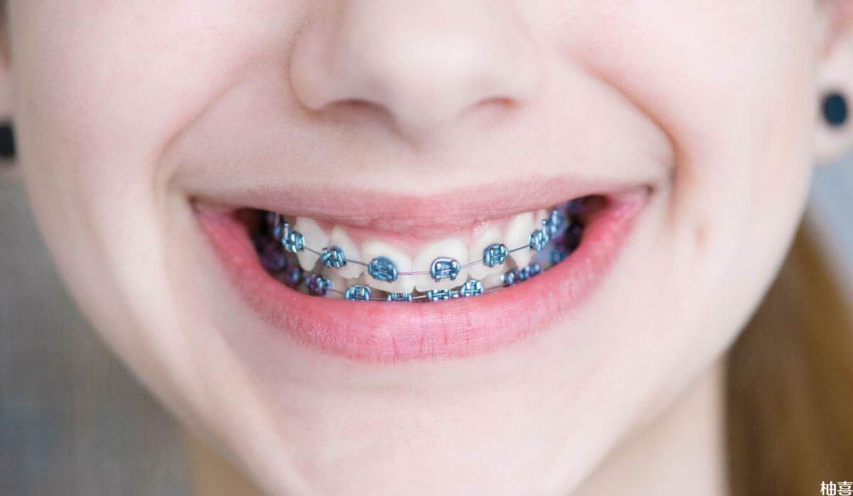 带牙套对孩子的心理健康有影响