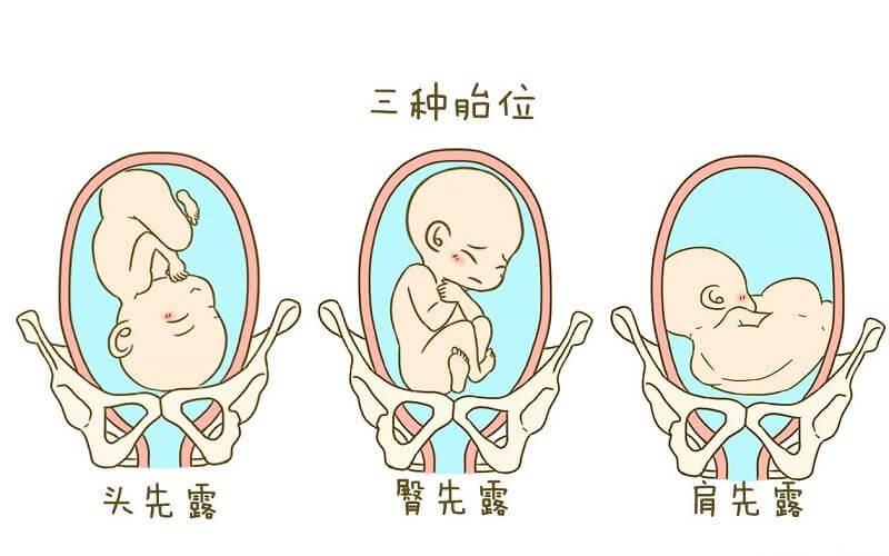 胎儿横位图