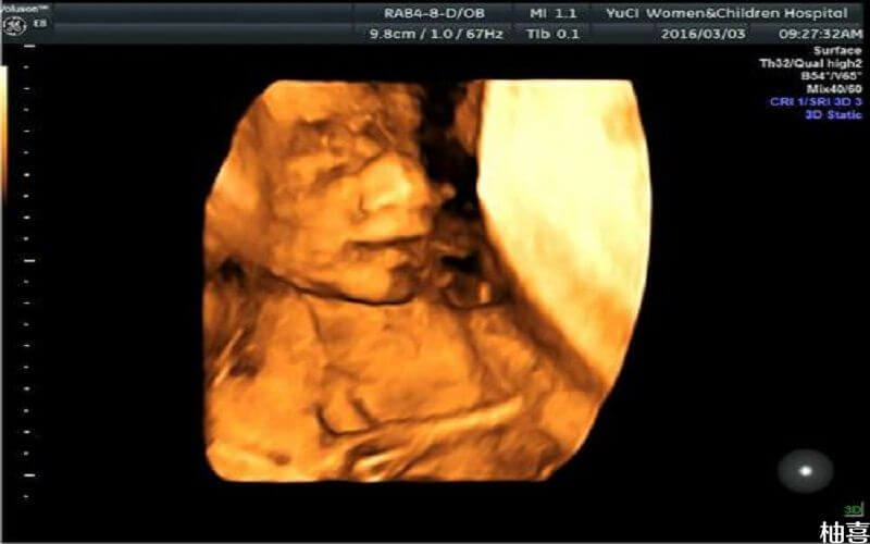 胎儿横位做四维彩超的注意事项