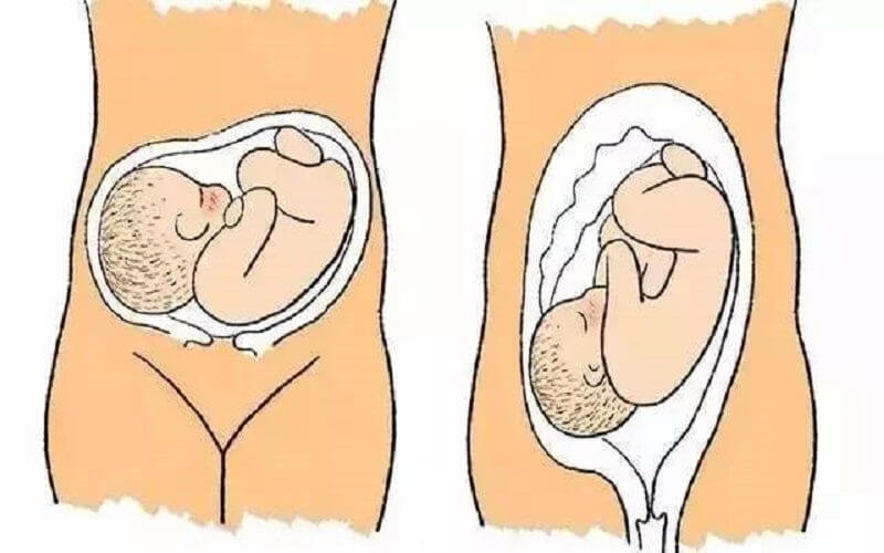 胎儿横位姿势图