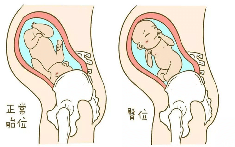 臀位是胎位不正常的一种