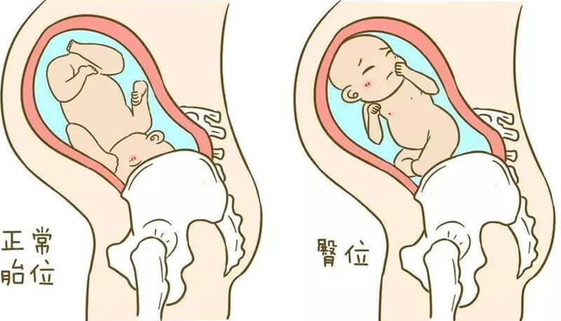 正常胎位与臀位对比图