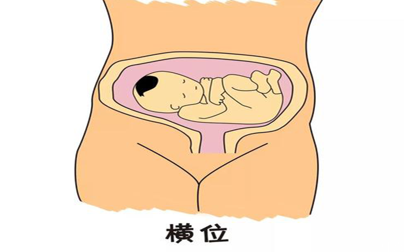 胎儿横位想顺产