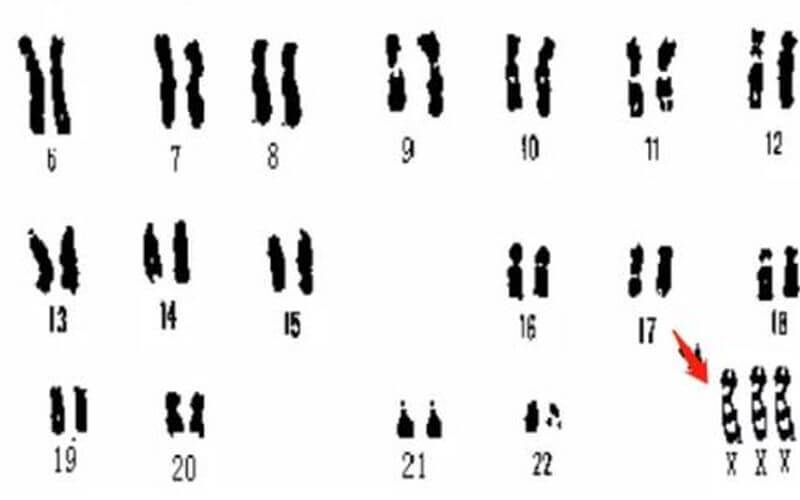 xxx綜合徵超雌綜合徵是什麼一種性染色體異常的疾病