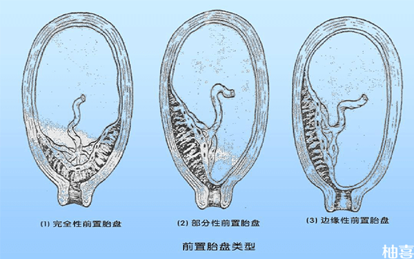 孕37周完全性前置胎盘不想提前剖腹产要怎么挨到足月？