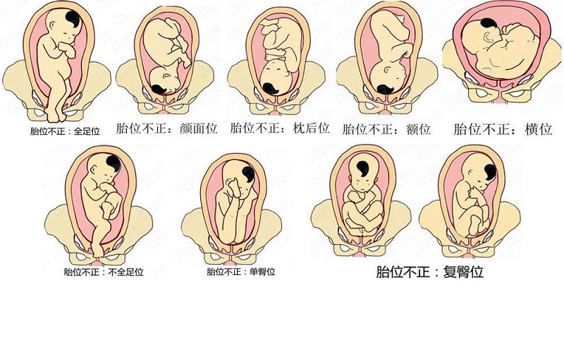 胎儿胎位示意图图片