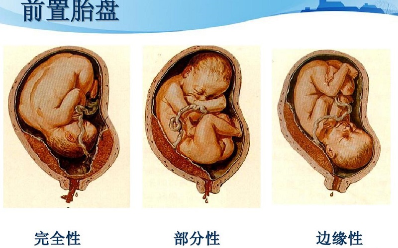 孕妇三大前置胎盘分类示意图