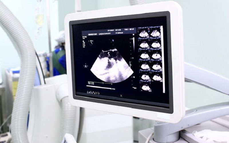 超声波检测胎儿图