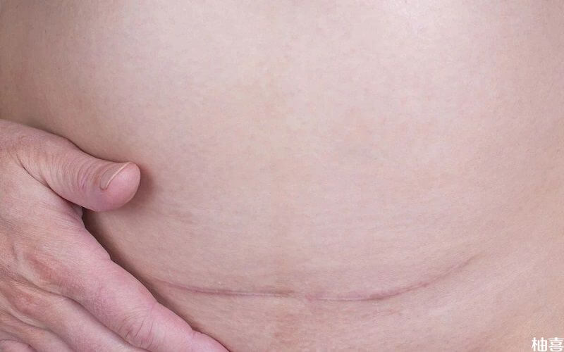剖宫产的疤痕图片