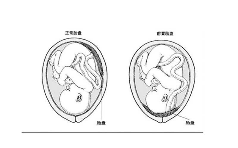 前置胎盘与正常胎盘的区别