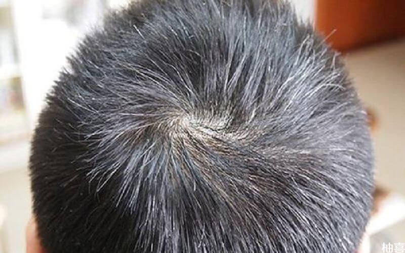 叶酸片能治白发吗