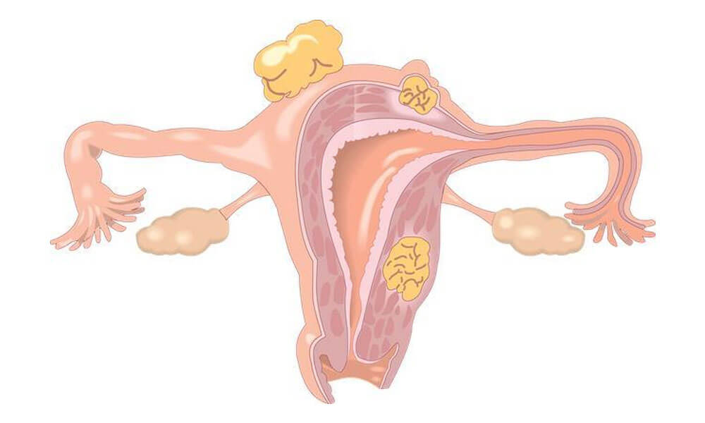 子宫破裂的诊断可从两方面下手，超声+症状准确率更高