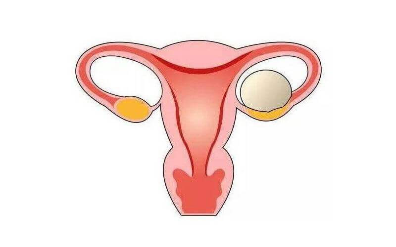 严重的卵泡囊肿会影响怀孕