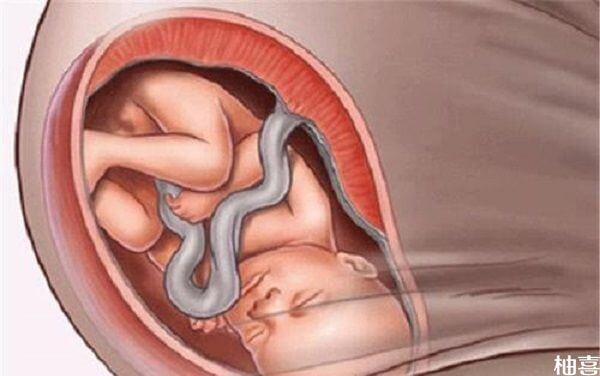 怀孕6个月长时间宫缩会导致胎儿缺氧发育畸形吗