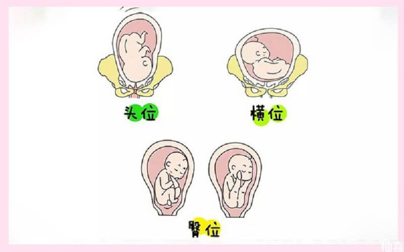 胎儿常见的胎位
