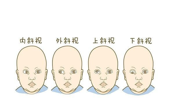 脑瘫宝宝的早期症状是不是面部呆滞？