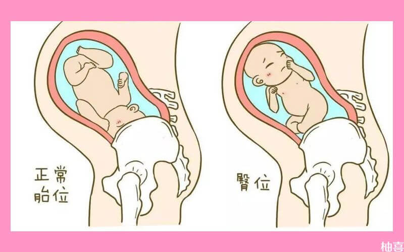 正常胎位和臀位对比图