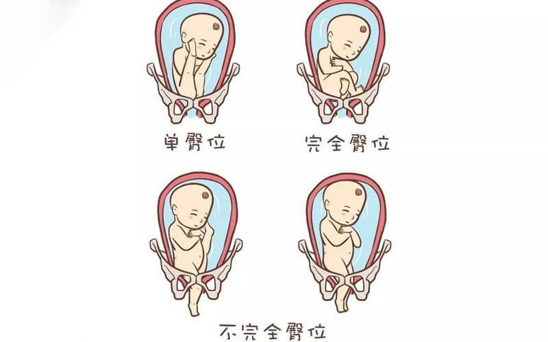 孕妇异常胎位图