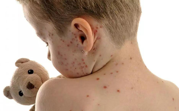 育儿冷知识：3分钟了解接种水痘疫苗为何还被传染