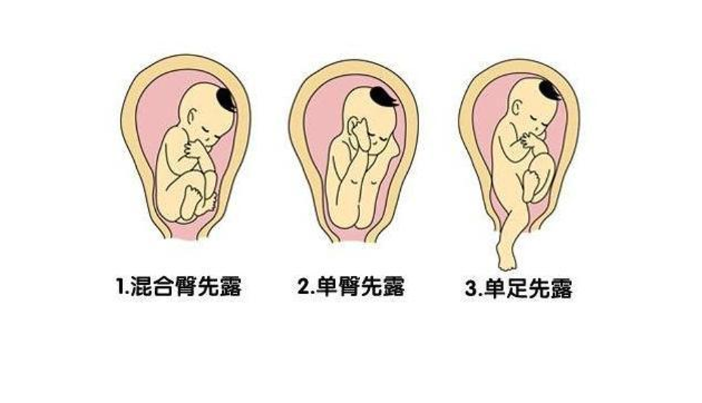 胎儿臀位姿势如图