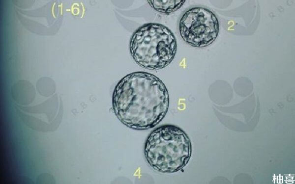 移植囊胚4开头还是5开头的好？
