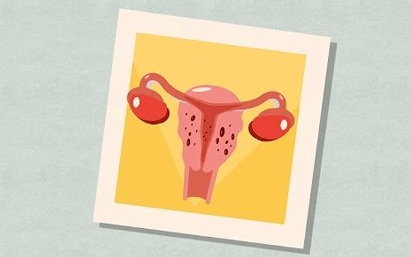 从子宫腺肌症的3种类型，告诉你这是什么病！