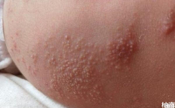 打完麻腮风疫苗宝宝出红疹子怎么处理？