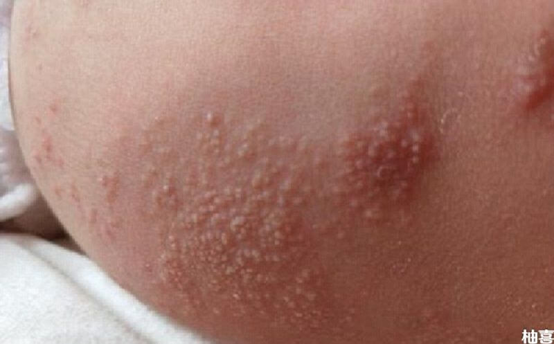 宝宝九个月出麻疹图图片