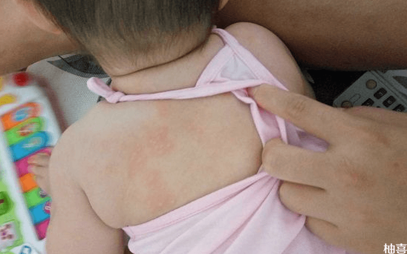 儿童湿疹的常见现象