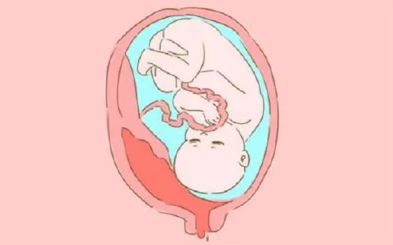 胎盘早剥孩子可能会出现大小便失禁的症状