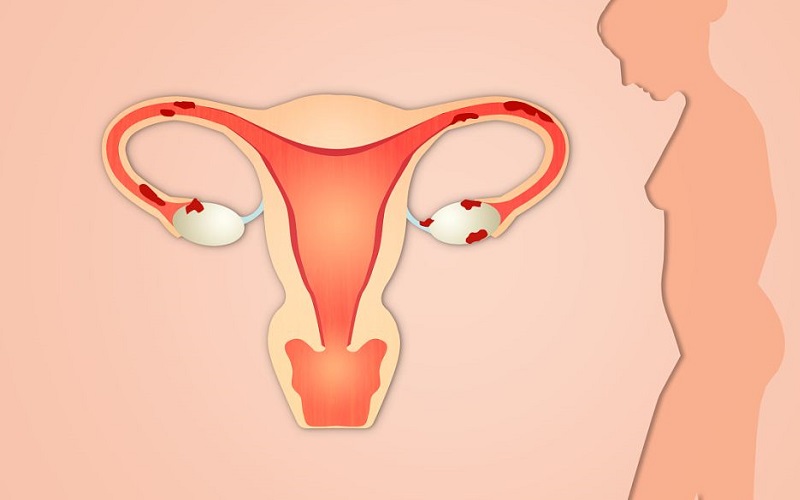 宫颈肥大可以用复方甲硝唑栓塞到阴道消炎