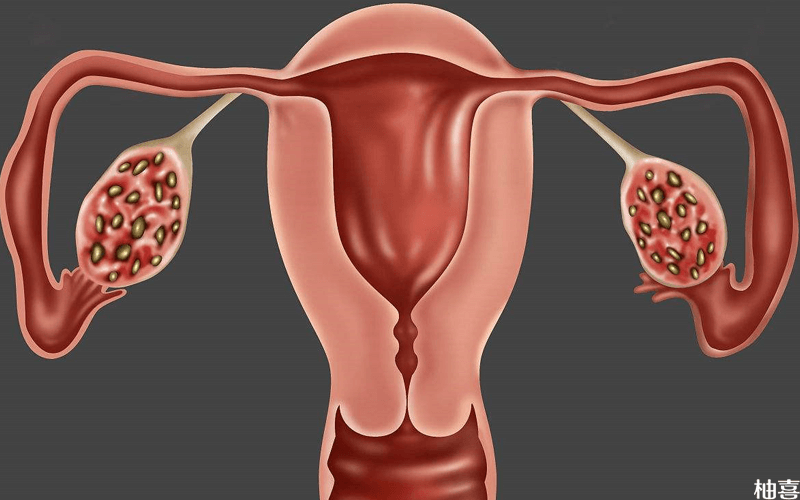 amh值偏高是多囊卵巢综合征