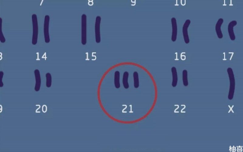 唐氏综合征21号染色体示意图