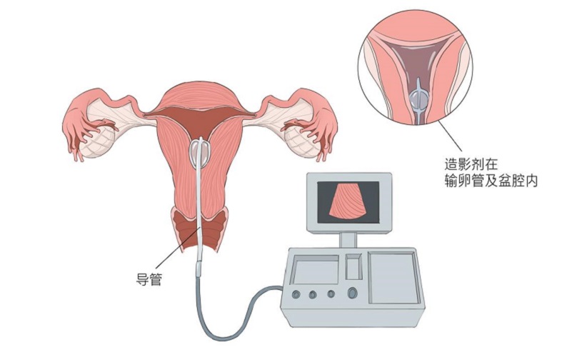 输卵管造影检查漫画示意图